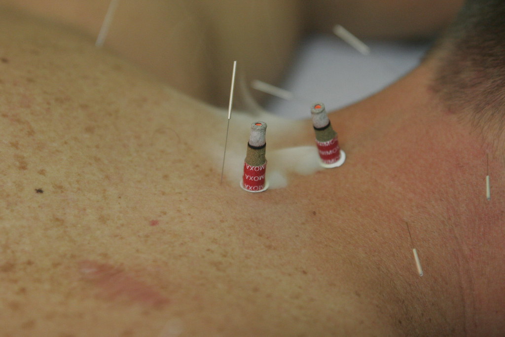 acupuncture treatment