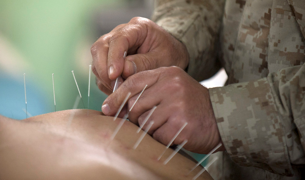 acupuncture